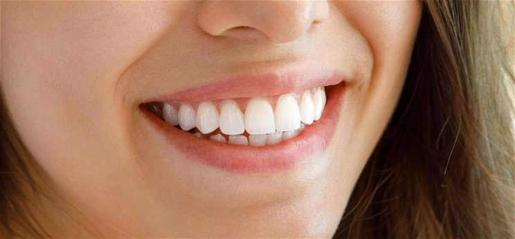 A szép fogsor valóban csak az anyagiakon múlik?